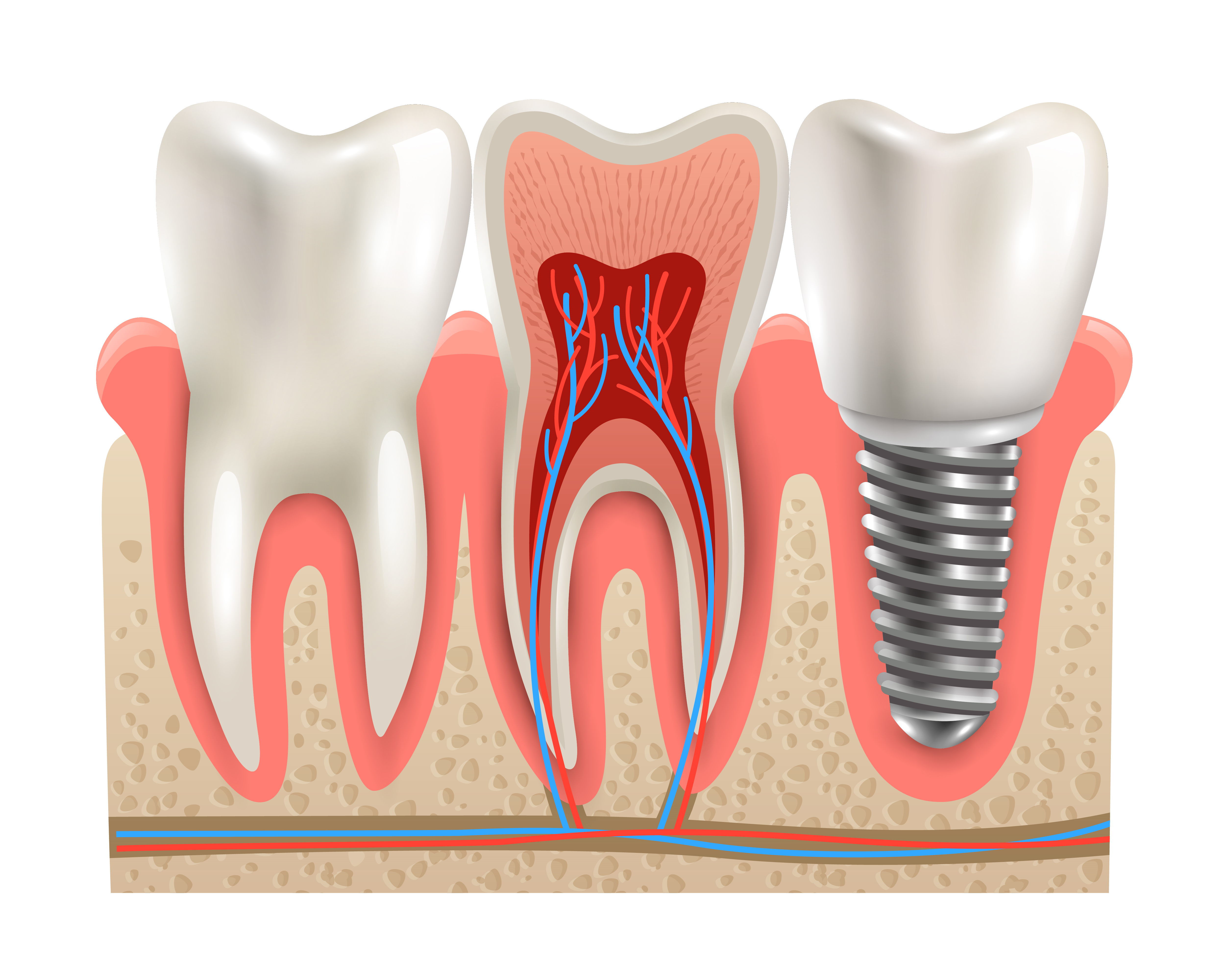 Evaluation of the Accuracy of Transferring Copings for Dental Implants Using Different Impression Techniques