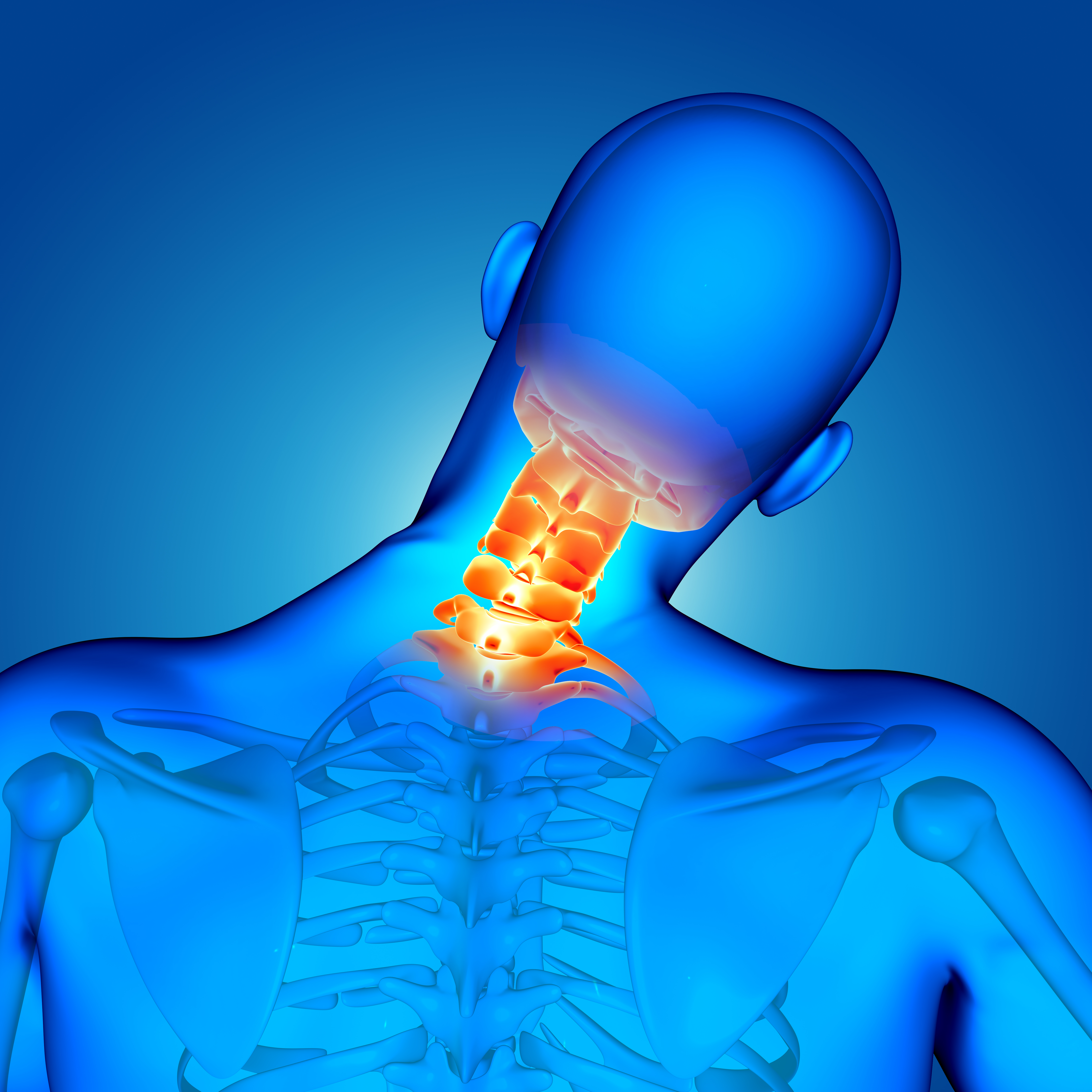 Bilateral Arcocristectomy in Cervical Spinal Stenosis via an Unilateral, Minimally Invasive Approach with a Tubular System