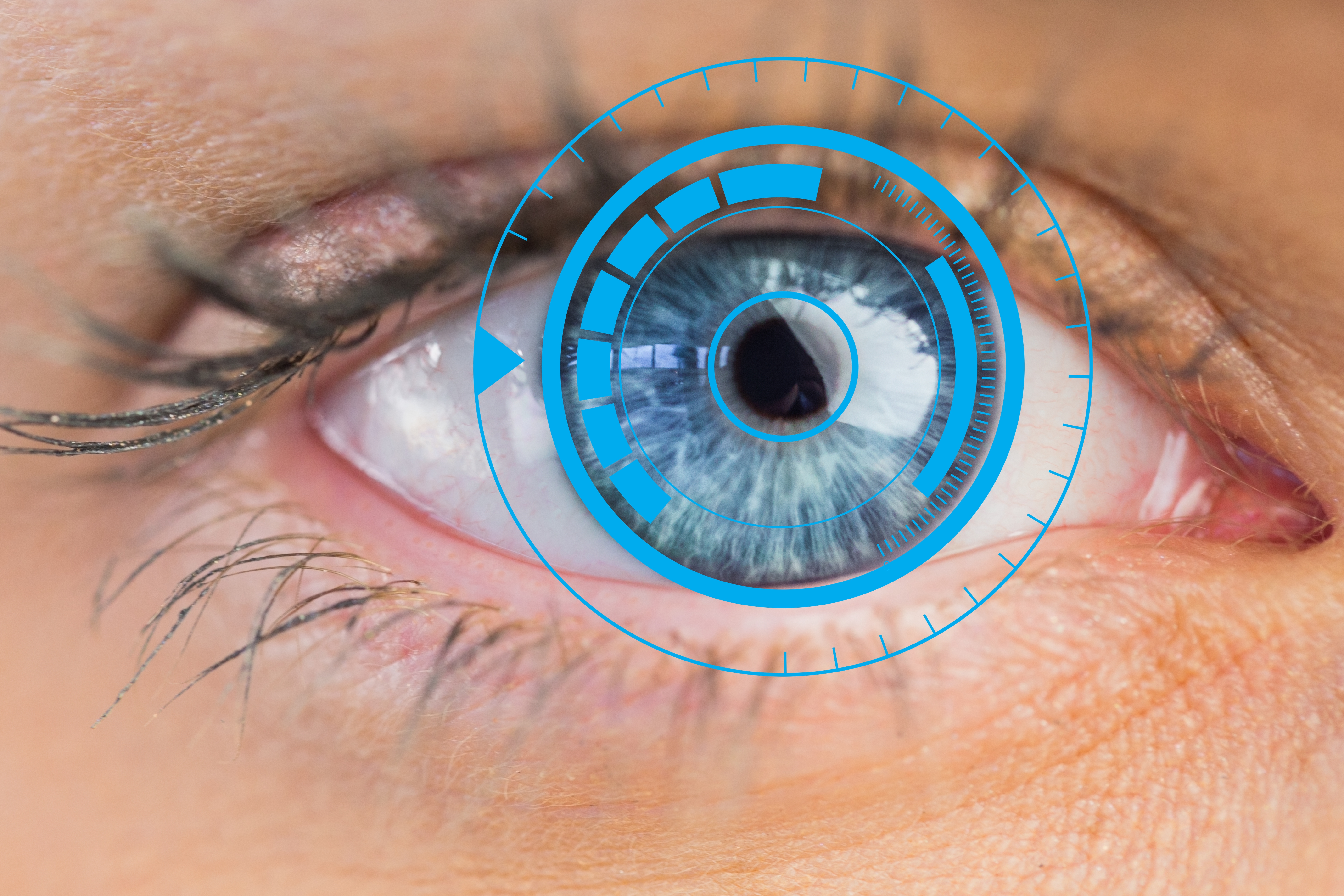 Corneal Remodeling of Laser Asymmetric Keratectomy Combined with Collagen Cross Linking in Patients with Keratoconus Suspect Corneal Remodeling of Laser Asymmetric Keratectomy Combined with Collagen Cross Linking in Patients with Keratoconus Suspect