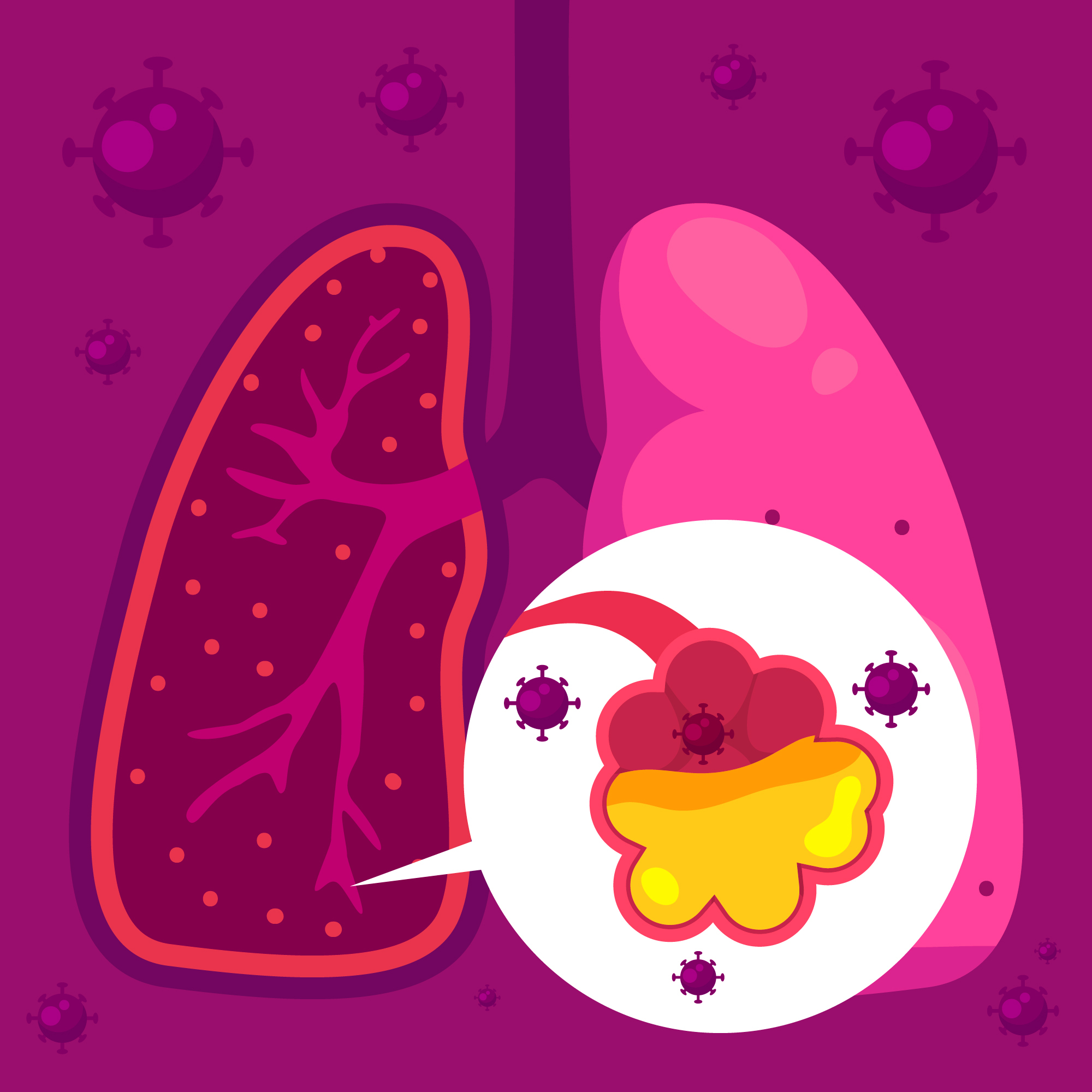 A Case Report of Long-Term Survival in Small Cell Lung Cancer Following Multiline Therapy