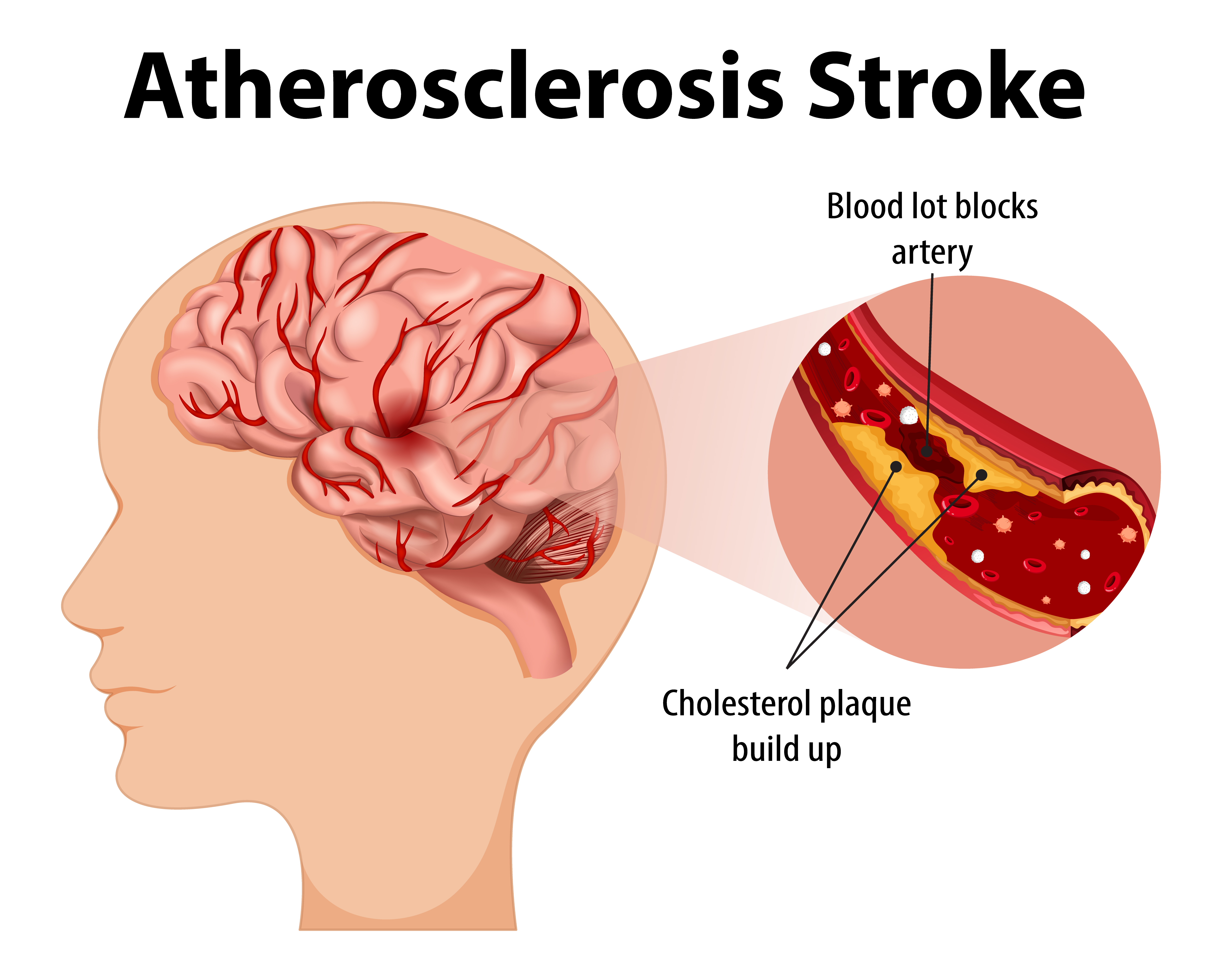 Delayed Hydrothorax in a Severe Case of Wernicke Encephalopathy