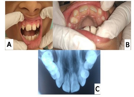Siamese Tooth- An esthetic Conundrum
