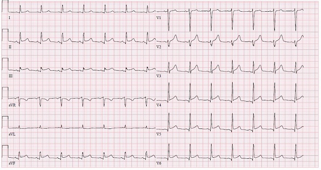 Acute Coronary Syndrome versus Takotsubo Cardiomyopathy: A Diagnostic Dilemma