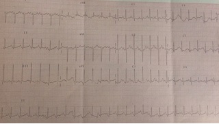 A Rare Case of Hypertrophic Cardiomyopathy Associated with Congenital Mitral Stenosis