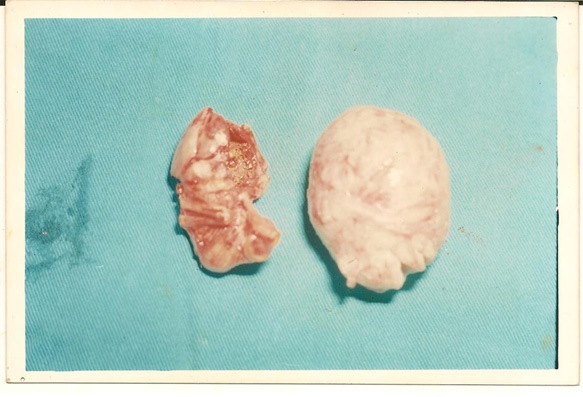 Deep Dyspareunia: Is It an Unusual Manifestation of Lithopedion? Deep Dyspareunia: Is It an Unusual Manifestation of Lithopedion?