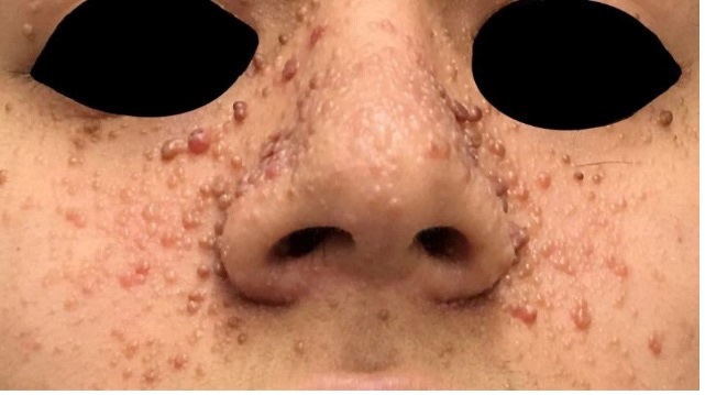 Oral Manifestations of Tuberous Sclerosis Complex in a Young Patient during Orthodontic Treatment