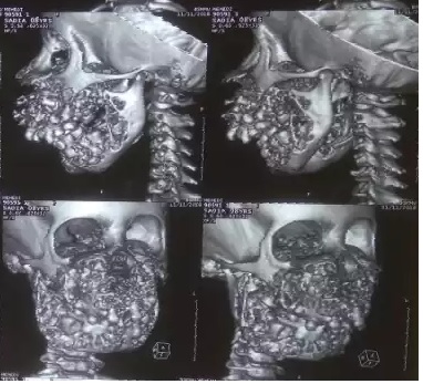 A Rare Case of Grade III Cherubisms A Rare Case of Grade III Cherubisms