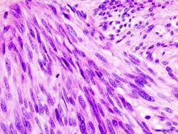 Pancreatic Extragastrointestinal Stromal Tumor in a Patient with Neurofibromas Presenting with Iron Deficiency Anemia