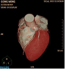 Coronary Anomaly: The Left Anterior Descending Coronary Artery Originating from the Proximal of Right Coronary Artery