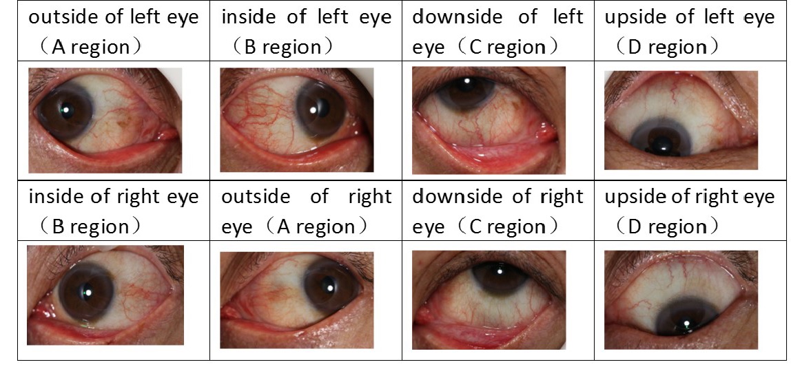 Artificial Intelligence-Based Eyefeature Imaging for Early Diabetes Aided Diagnostics