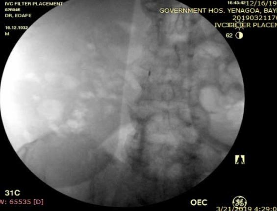 Common Indications and Retriever of IVC Filter Placement in Nigeria: Three Case Series