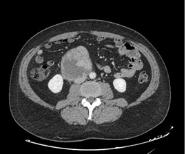 Vascular Retroperitoneal and Pelvic Leiomyosarcoma a Rare Disease Requiring Complex Surgery