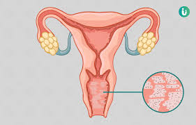 Diagnosis of Bacterial Vaginosis Using a Novel Molecular Real-Time PCR Test