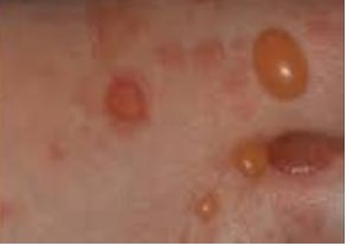 A Case Report on Bullous Pemphigoid- Its Management with Dexamethasone and Its High Efficacy