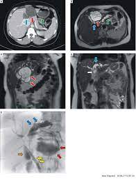 Hepatic Mucinous Cystic Neoplasm with Fistulation to The Duodenum: A Rare Case of Recurrent Cholangitis