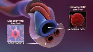 Umbilical Cord Mesenchymal Stem Cells Limit Post-Stroke Infection