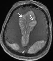 Typical Presentation of Erdheim-Chester Disease: A Case Report