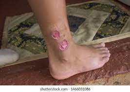 Cutaneous leishmaniasis in the Thiès Region in Senegal