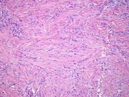 Solitary Cutaneous Atypical Leiomyoma: An Unusual Variant Histologic - A Diagnostic Challenge