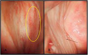 The Socio-Economic Cost of Vulvovaginal Atrophy (VVA) in Breast Cancer Survivors: An Italian Expert Consensus Statement On VVA Management