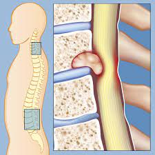 Surgical Treatment of Spinal Tumors with Modified Laminoplasty: Preliminary Study