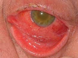 Analysis of 148 Cases of Endophthalmitis Treated at a Tertiary Referral Hospital in Italy from 2011 To 2019
