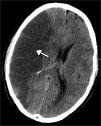 Cerebrovascular Accident (Stroke) Activated by Guillain Barré Syndrome