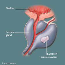 Relationship between Genetic Variants of Glucuronidation Pathway and TNF-Α with Increased Risk of Prostate Cancer in Iranian Men