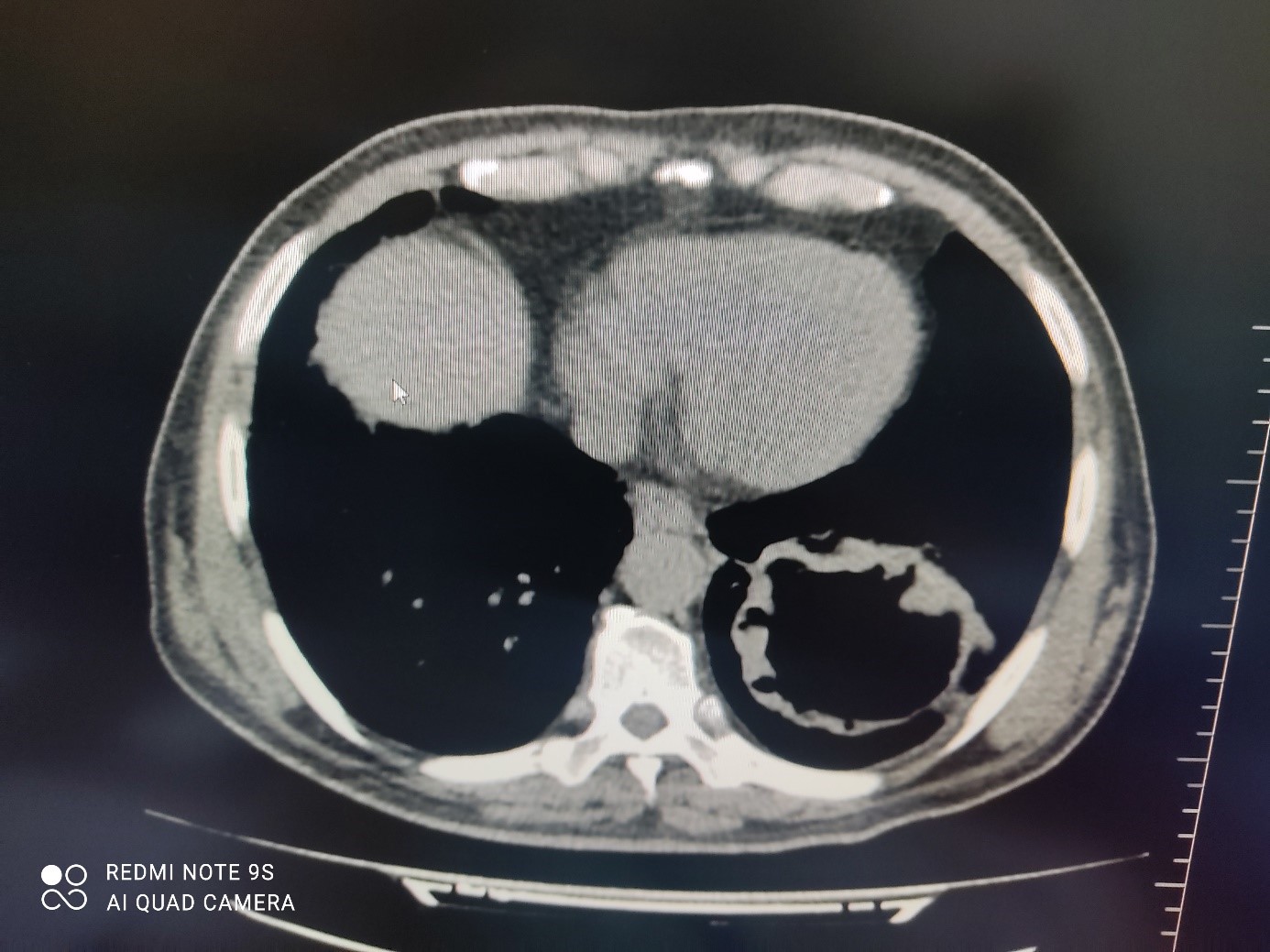 A Pulmonary Metastasis of a Mixed Germ Cell Tumor of Testis with Active  Covid-19 İnfiltration of the Lungs