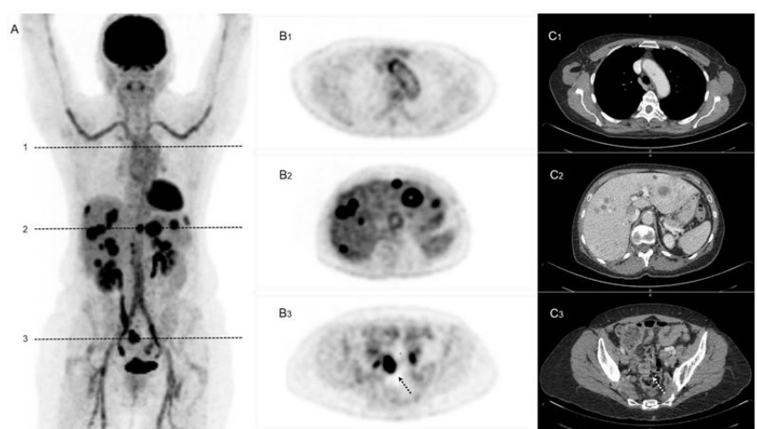 Concomitant Finding of a Large Vessel Vasculitis and a Colorectal Neoplasia on  FDG PET/CT
