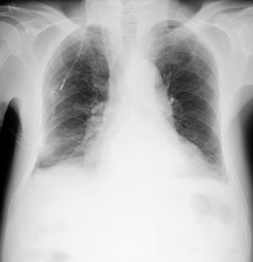 A Rare Case of ARDS: Combination of G-CSF and Chemotherapy for Pancreatic Cancer A Rare Case of ARDS: Combination of G-CSF and Chemotherapy for Pancreatic Cancer