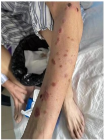 One Rare Case of Paraneoplastic Pemphigus Associated with Dedifferentiated Liposarcoma