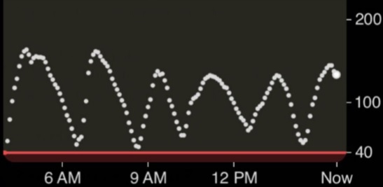 Preventing Severe Hypoglycemia with a Continuous Glucose Monitor Device in an Infant with Glycogen Storage Disease 1a undergoing a Gastrostomy Tube Placement: Case Report