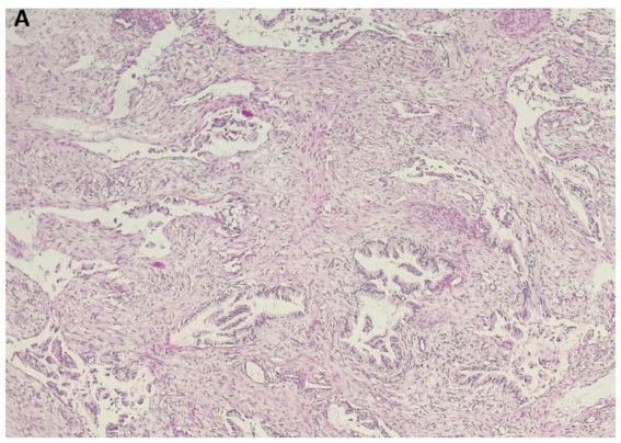 Unusual Metastasis in The Cervix: About a Case